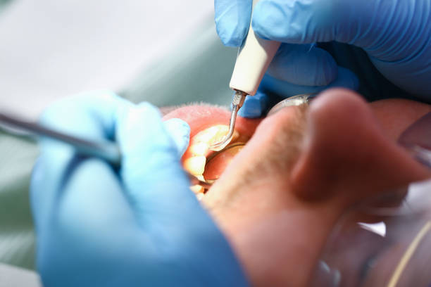 Best Emergency Dentist for Knocked-Out Tooth in North Pearsall, TX