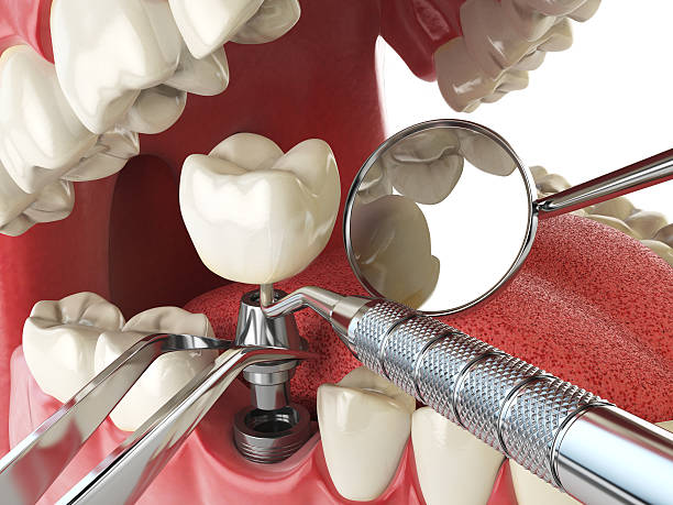 Best Emergency Dentist for Lost Fillings or Crowns in North Pearsall, TX